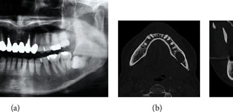 A Rare Case Of Pyogenic Granuloma In The Tooth Extraction Socket