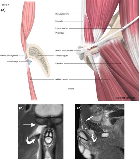 Type 1 Plac Injury Complete Fibrocartilage Fc Avulsionpyramidalis