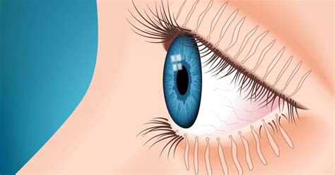 Meibomian Gland Dysfunction All About Vision