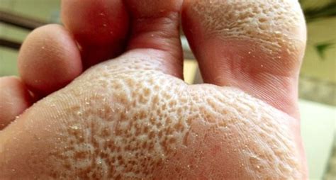 What Are Those Tiny Holes Or Craters Under The Ball Of The Foot Croydon Total Footcare