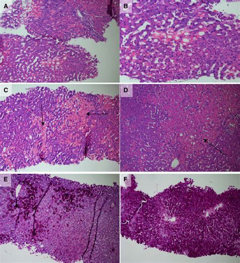 Histological Findings In Liver Biopsies Panels A And B Show