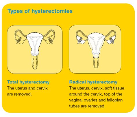Types Of Hysterectomy For Cervical Cancer