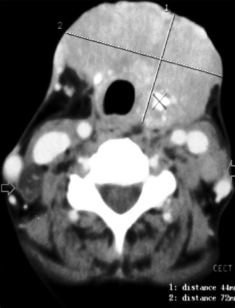 Neck Ct Scan Showing Calcifications And Enlarged Lymph Nodes Arrow