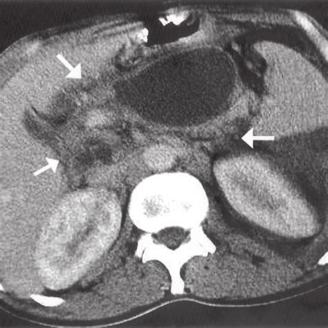 Contrast Enhanced Ct Of Abdomen Showing Enlarged Pancreas White