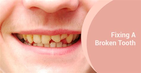 How Do You Fix A Broken Tooth Oakville Place Dental