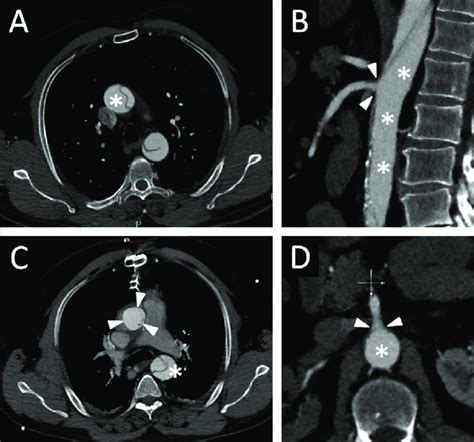 Ct Angiography Of The Aorta Shows Aortic Dissection Before A And