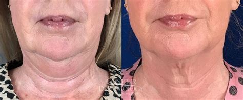 Kybella Treatment To Eliminate Double Chins