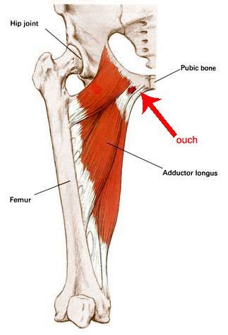 If you have groin pain, you shouldn't just shrug it off. Right Groin Pain Female | ... pain in the left upper-thigh ...