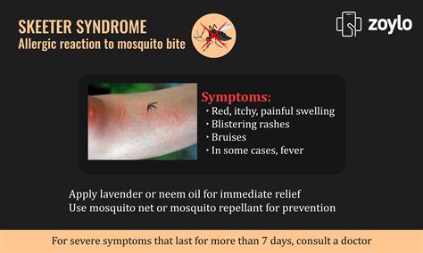 Skeeter Syndrome Allergic Reaction To Mosquito Bite Mosquito Bite Syndrome Allergic Reaction