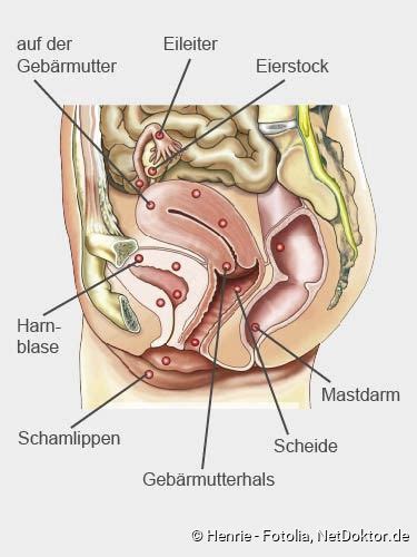Endometriosis is a painful condition in which endometrial tissue grows outside the uterus, often in the pelvic area. Endometriose: Beschreibung, Symptome, Folgen, Behandlung ...