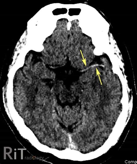 Rit Radiology Hyperdense Middle Cerebral Artery Sign