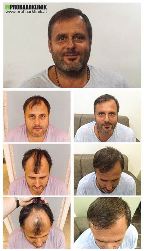 Willkommen bei haarentfernung & haartransplantation. Haartransplantation Vorher Nachher Bilder der ...
