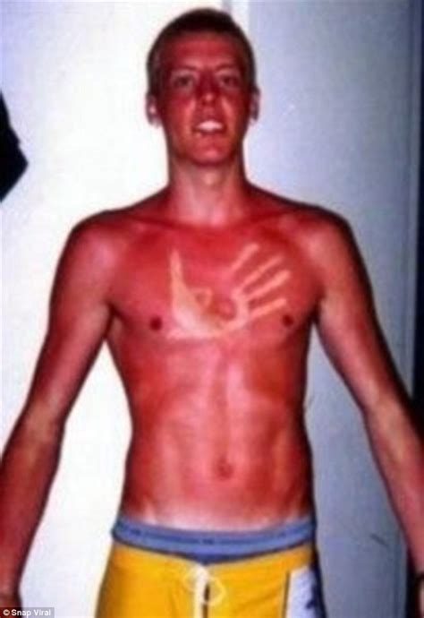 Sunburn Images Show Epic Tan Fails And Bruised Egos To Match Daily Mail Online