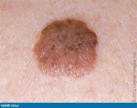 Cases In Actinic Keratosis The Often Overlooked Condition