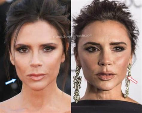 Victoria Beckham Before And After 2022