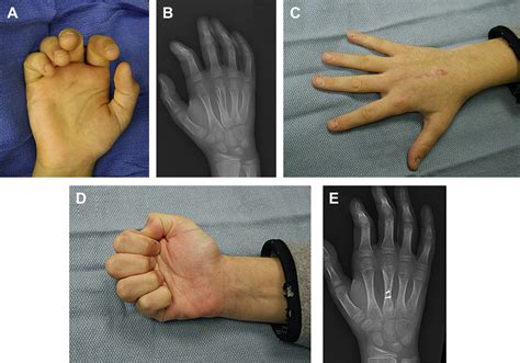 Treatment Of Nonunion And Malunion Following Hand Fractures Clinics