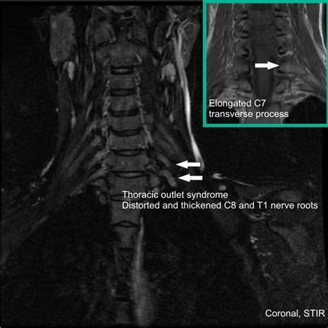 Thoracic Outlet Syndrome Treated With Cervical Rib Resection Image