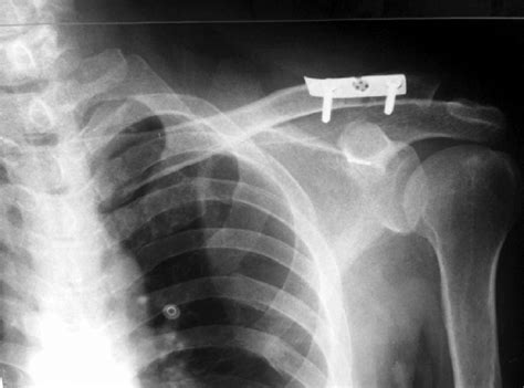 Type Iii Acromioclavicular Joint Dissociation Fig 2 Radiograph