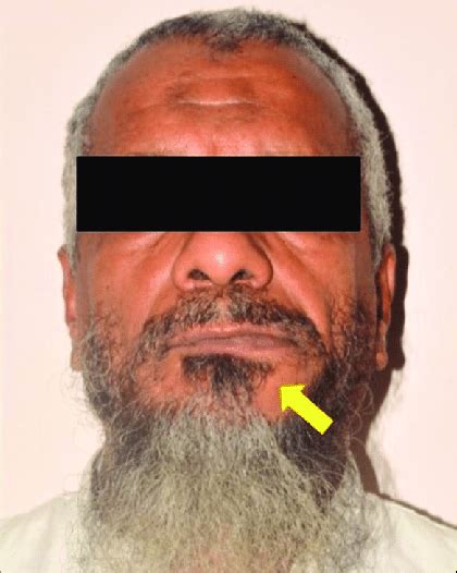 Extraoral View Showing Diffuse Swelling Over Left Parasymphysis Region