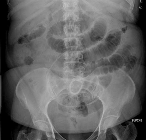 Supine Abdomen X Ray Showed Small Bowel Dilatation And Open I
