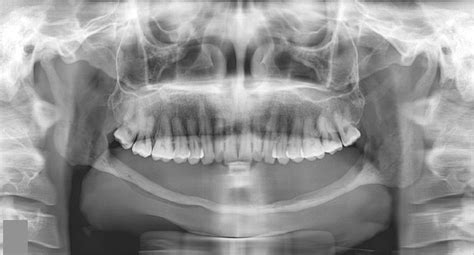 Gorham Disease Of The Mandible A Report Of Two Cases And A Literature Review Oral Surgery