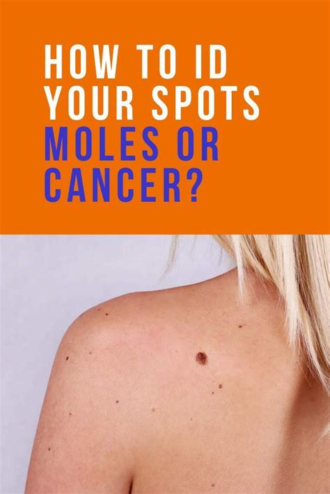 Pin By Lovelifeloveies On Health In 2020 Cancerous Moles Extreme Skin Skin Care Secrets