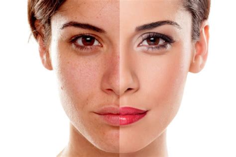 What Is Skin Discoloration On Face And How To Get Rid Of It