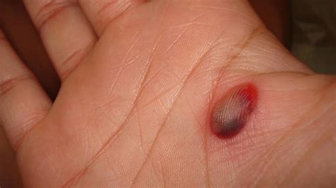 Melanoma Vs Blood Blister Symptoms Causes When To See A Doctor