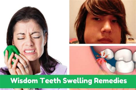 How To Treat Swelling From Wisdom Tooth Extraction Diy