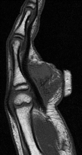 Calcifying Aponeurotic Fibroma Of The Hand Radiologic Differentiation