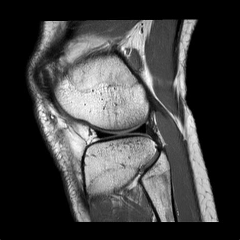 Normal Knee Mri Sagittal View 2 Diagram Quizlet