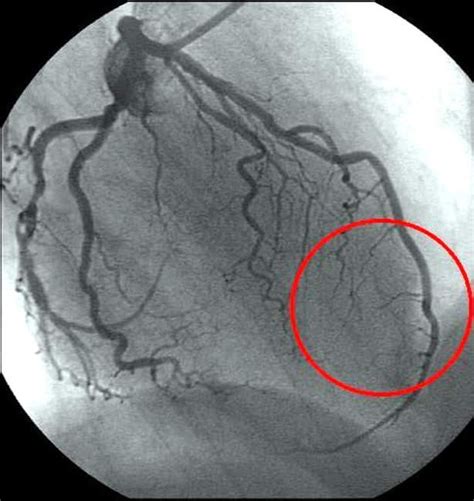 Imaging Of All Three Coronary Arteries By Transthoracic