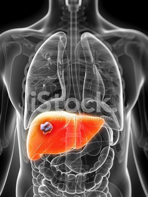 Liver Cancer Stock Photo Royalty Free Freeimages