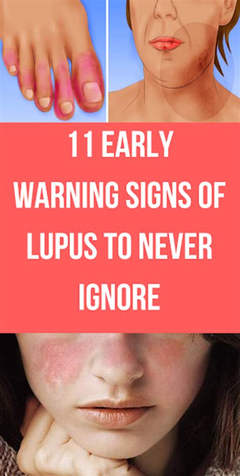 11 Early Warning Signs Of Lupus To Never Ignore Skin Symptoms