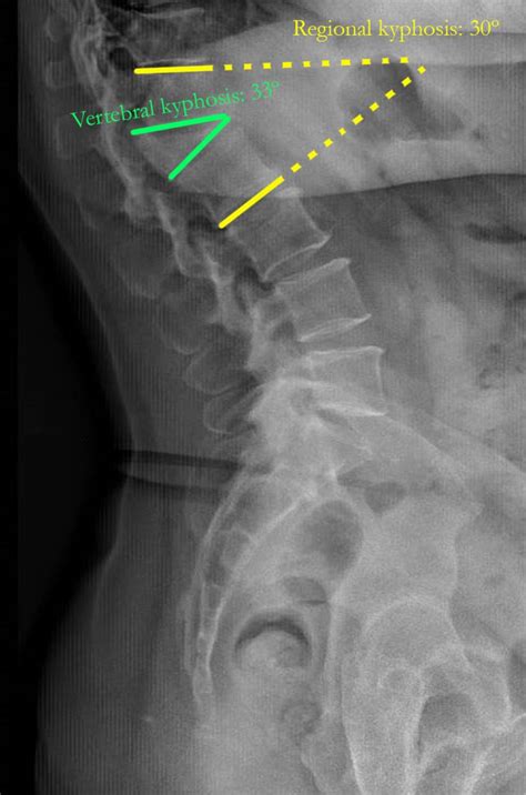 Simplified Pedicle Subtraction Osteotomy For Osteoporotic Vertebral