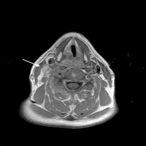 Head And Neck Mri Images Transverse T2 Weighted Image T2wi A