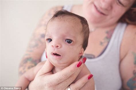 A Child Born With A Rare Genetic Defect Entered The World With The