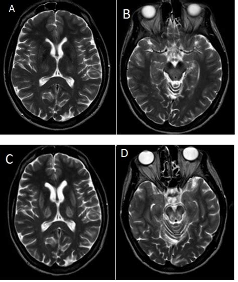 Axial T2 Weighted Mri Of The Brain In July Of 2014 Showing Hyperintense