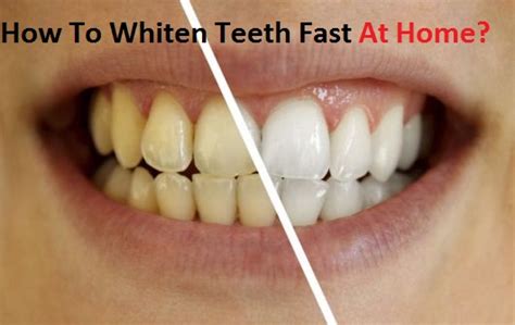 How To Whiten Teeth Fast At Home