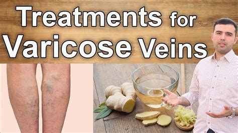 Natural Cures For Varicose Veins 10 Best Supplements Herbs And Diets For Varicose Youtube