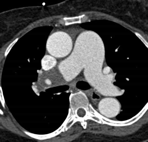 Chronic Pulmonary Embolism In Right Main Pulmonary Artery With Enlarged