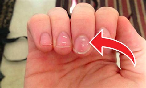 White Spots On Your Nails Here Is What They Indicate