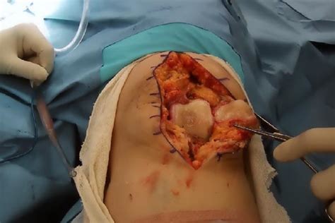 Removing of very painful knee joint affected by accident or arthritis. Knee Replacement Surgery