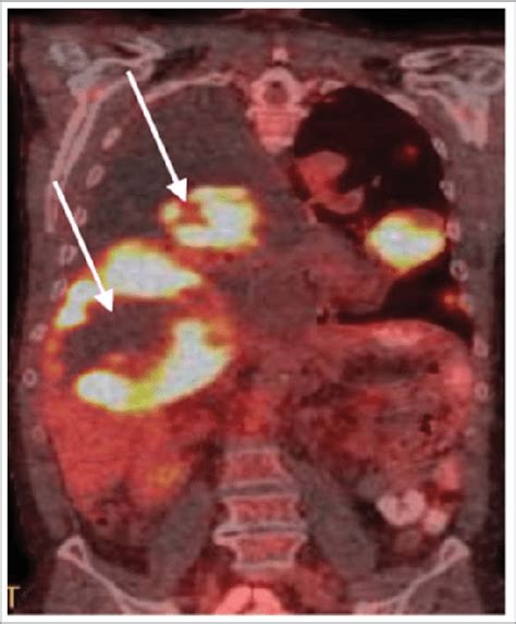 Pet Ct Showing Tumor Central Necrosis And Pseudoprogression In A