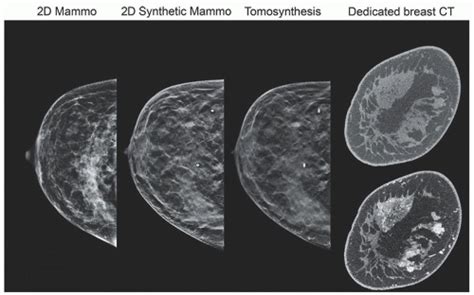 Breast Imaging Mammography Radiology Key