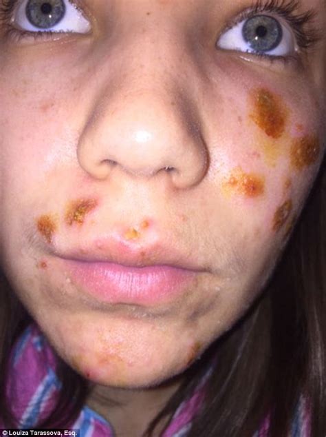 Woman Left With Severe Blisters From Botched Chemical Peel Daily Mail