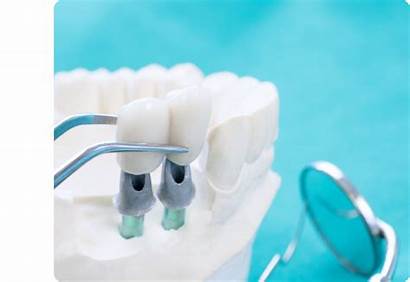 Dental Implants Gentle Centre Implant Team Wellington
