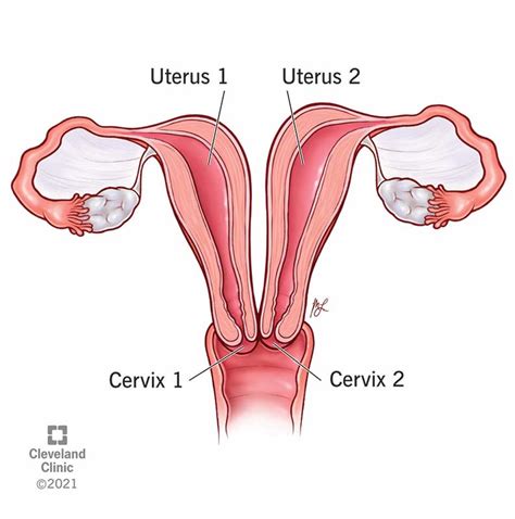 Uterus Didelphys Causes Symptoms Diagnosis Treatment
