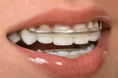 Smear toothpaste on a toothbrush with soft bristles. Six Month Smiles - Machnowski, DDS | Woodridge, IL