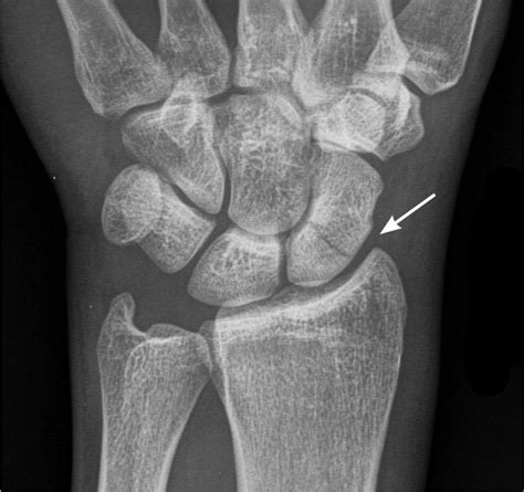 Commonly Missed Radiographic Findings 2016 02 05 Ahc